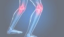 Arthrosetherapie Gemeinschaftspraxis Orthopädie und Unfallchirurgie Heilbronn Dr. med. Carlo Bussi